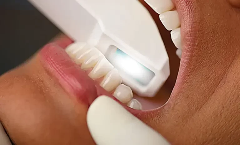 بررسی اسکنر داخل دهانی یوجوی (Youjoy)