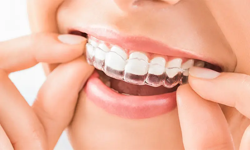 نایت گارد (Night Guard) پوشش پلاستیکی محافظی برای دندان‌ها است که از ساییده شدن آنها هنگام دندان قروچه جلوگیری می‌کند.