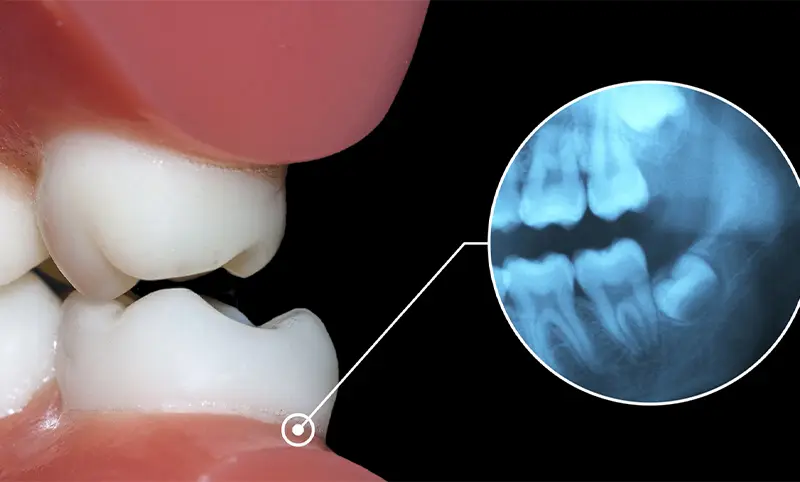 رادیوگرافی دندان اکلوزال در شرایطی انجام می‌شود که فک بیمار بسته است.