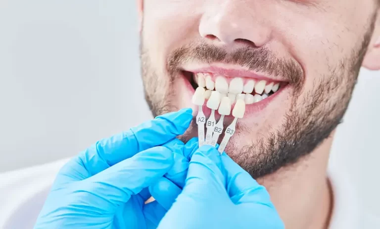 ساخت روکش دندان با اسکنر داخل دهانی