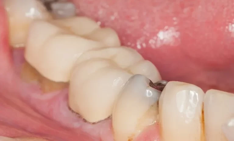 پیشگیری از پوسیدگی دندان ؛ راهنمایی جامع مراقبت از دندان‌ها