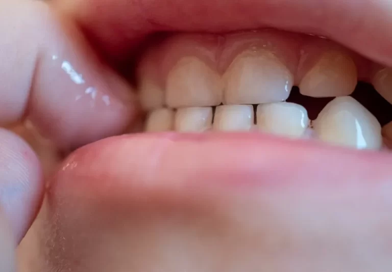 دندان قروچه: علل، علائم و درمان‌های مؤثر