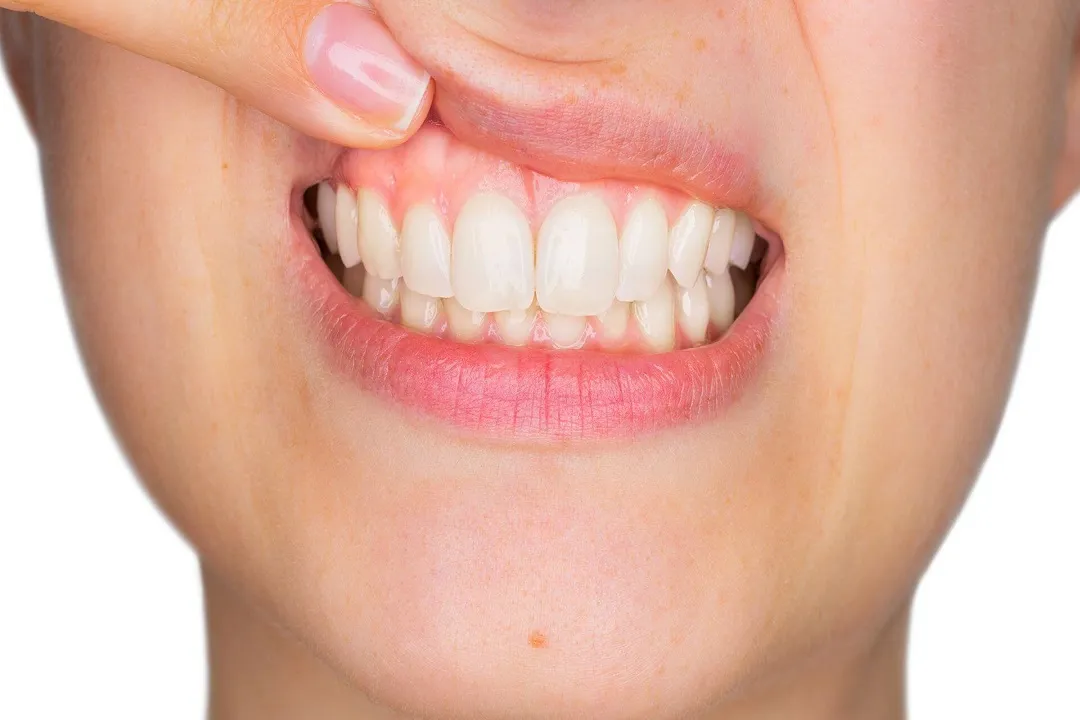 شناخت علائم اولیه بیماریهای لثه میتواند به جلوگیری از پیشرفت آنها کمک کند.