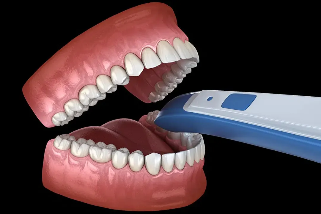 استفاده از اسکنرهای داخل دهانی (Intraoral Scanners) فرآیند قالبگیری سنتی را سادهتر و دقیقتر کرده است.
