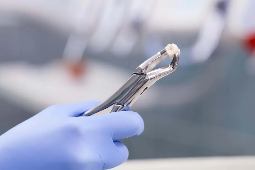 کشیدن دندان عقل به صورت جراحی (Surgical Extraction) یا ساده (Simple Extraction) انجام میشود.