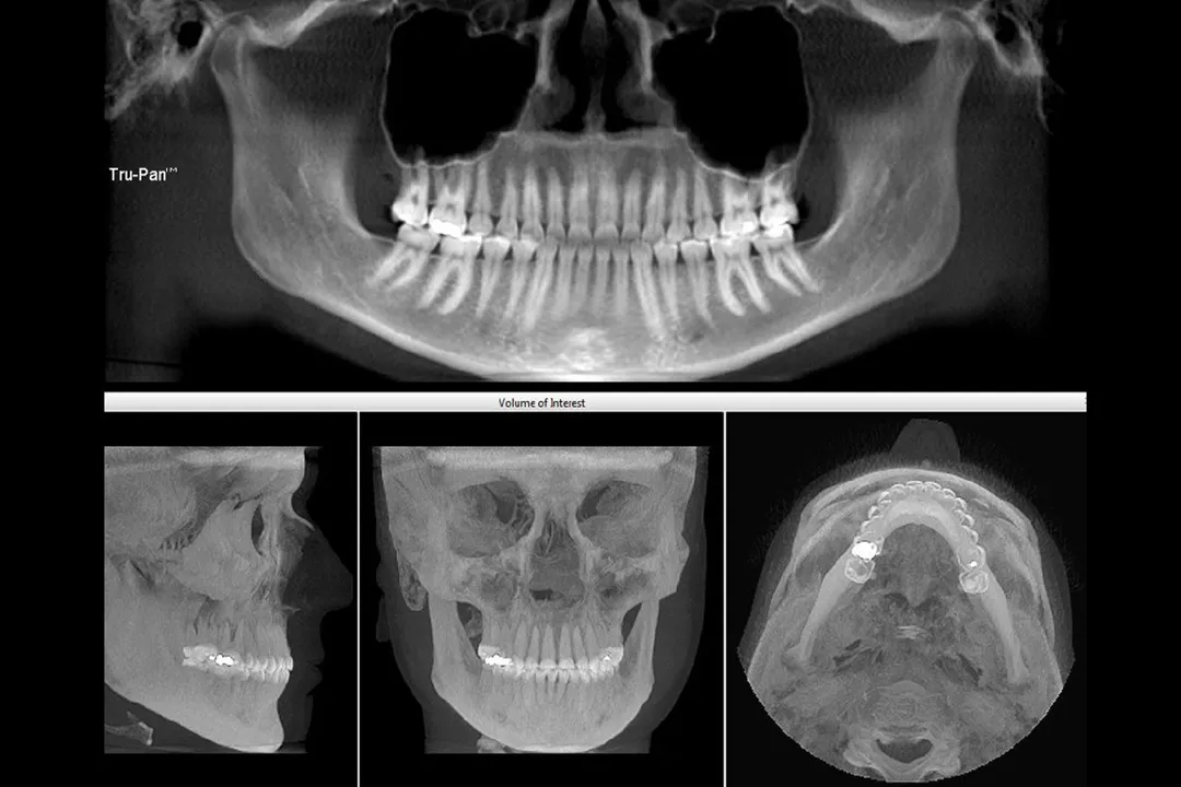 فناوریهایی مانند CBCT (تصویربرداری سهبعدی با استفاده از اشعه مخروطی) و اسکنهای دیجیتال، امکان برنامهریزی دقیقتر و تشخیص بهتر مشکلات دندانی را فراهم کردهاند.