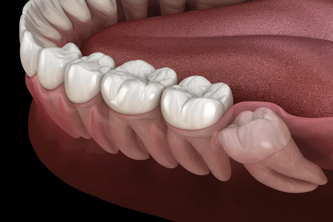 دندان عقل (Wisdom Tooth) که به عنوان سومین دندان آسیاب نیز شناخته میشود