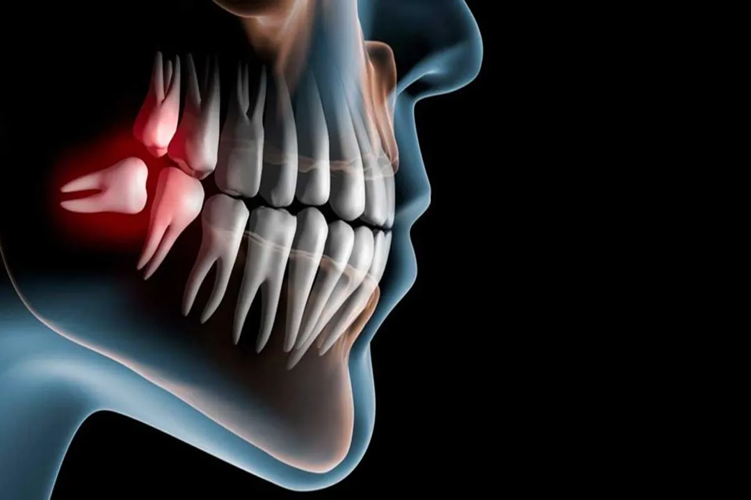 کشیدن دندان عقل یکی از رایج‌ترین جراحی‌های دهان و دندان است