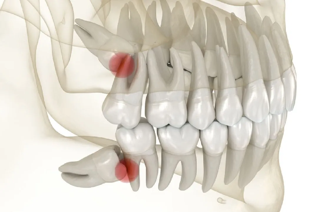 دندان‌های عقل نهفته (Impacted Wisdom Teeth) که نیاز به جراحی دارند، به مراقبت‌های بیشتری نیاز دارند