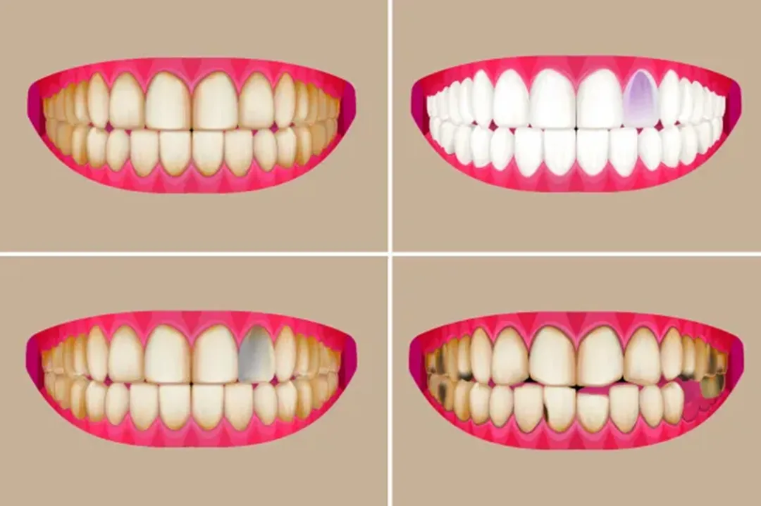 یکسان بودن رنگ دندانها یکی از عوامل کلیدی در زیبایی لبخند و اعتمادبهنفس افراد است
