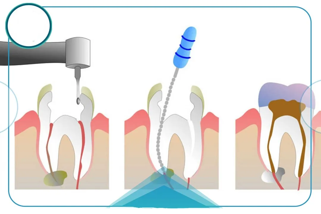 اصطلاح درست و دقیق برای این نوع درمان دندانپزشکی، «عصبکِشی» است