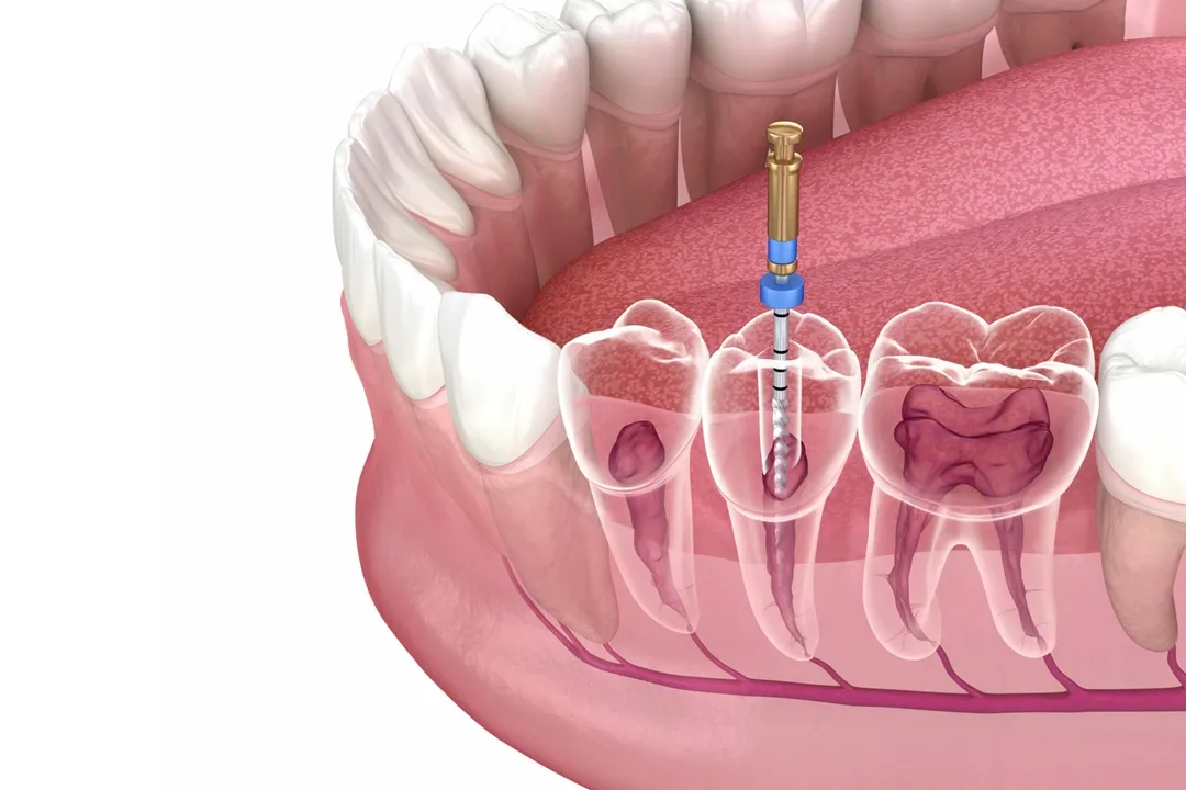 درمان ریشه (Root Canal)