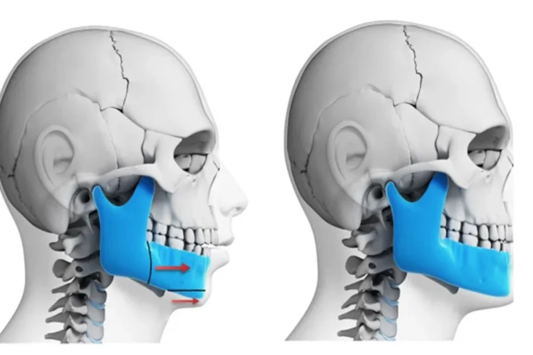 تفاوت فک جلو و عقب و تأثیر آن بر سلامت و زیبایی صورت